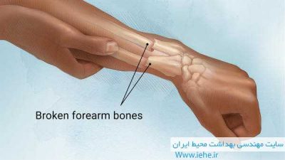 پاورپوینت شکستگی استخوان