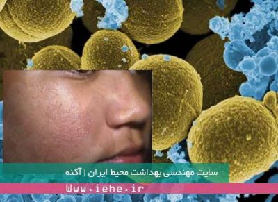 پاورپوینت آکنه،بیماری آکنه ، دانلود پاورپوینت برای آکنه