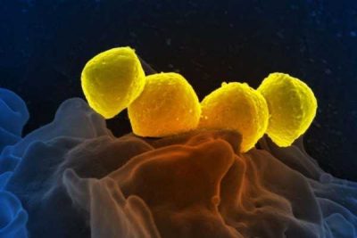 بیماری فاشیت نکروزان باکتری استرپتوکوک پیوژن بیماری گوشت خوار NECROTIZING FASCIITIS FLESH-EATING DISEASE