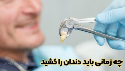 چه زمانی دندان نیاز به کشیدن دارد + معرفی دندانپزشک خوب در تبریز