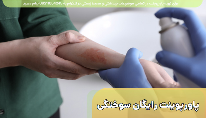 دانلود پاورپوینت سوختگی