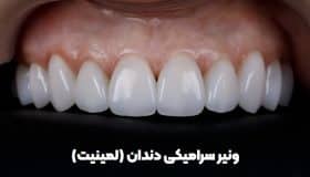 ونیر سرامیکی دندان - لمینیت سرامیکی - ونیر سرامیکی تبریز - بهترین دندانپزشک ونیر در تبریز