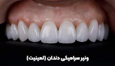 ونیر سرامیکی دندان - لمینیت سرامیکی - ونیر سرامیکی تبریز - بهترین دندانپزشک ونیر در تبریز