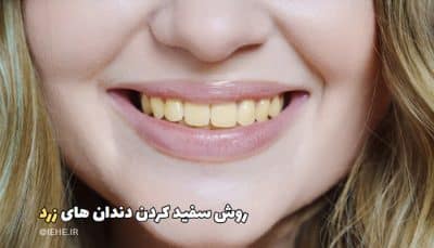 بهترین روش های سفید کردن دندان های زرد با ونیر کامپوزیتی بلیچینگ در تبریز و لمینیت سرامیکی در تبریز
