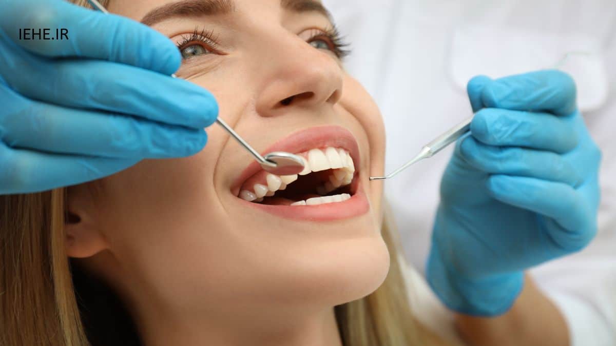 لبخند هالیوودی با ونیر کامپوزیتی به شکل سلبریتی ها در تبریز