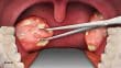 عمل برداشتن لوزه در بزرگسالان Tonsillectomy