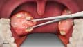 عمل برداشتن لوزه در بزرگسالان Tonsillectomy