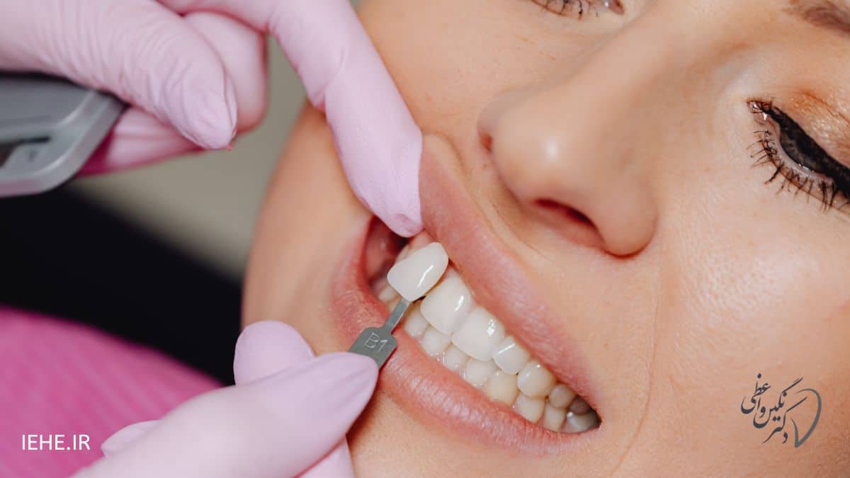 مزایا و معایب کامپوزیت ونیر در تبریز برای اصلاح طرح لبخند و بازسازی آن با قیمت ارزان