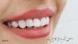 همه چیز درباره اصلاح طرح لبخند به روش کامپوزیت ونیر