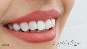همه چیز درباره اصلاح طرح لبخند به روش کامپوزیت ونیر