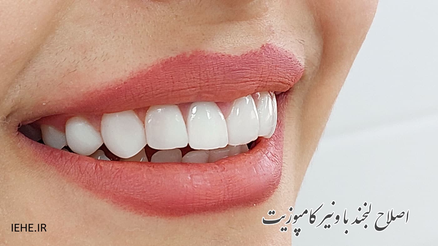 همه چیز درباره اصلاح طرح لبخند به روش کامپوزیت ونیر