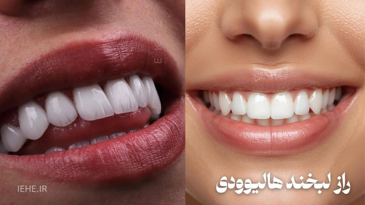 لبخند هالیوودی مردانه لبخند هالیوودی زنانه لبخند سلبریتی ها