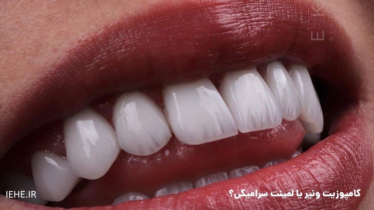 مقایسهٔ سریع: کامپوزیت ونیر یا لمینت سرامیکی