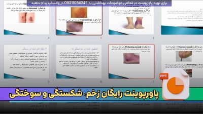 دانلود پاورپوینت رایگان زخم، شکستگی و سوختگی ppt قابل ویرایش