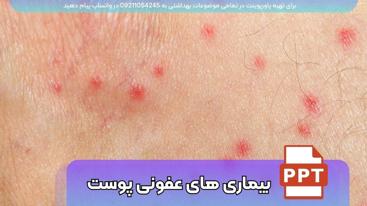 دانلود پاورپوینت بیماری های عفونی پوست - 74 اسلاید فارسی